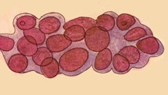 子宫内膜异位症
