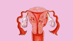 子宫内膜肌腺症