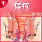 痔疮