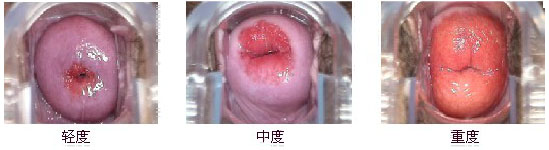 <strong>海扶刀宫颈修复术：微创除糜，完美修复宫颈!</strong> 